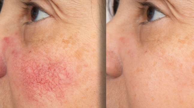 Labiose Sérum Anti-Rougeurs